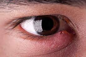 top 6 causes of swollen eyelids