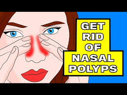 how to shrink your nasal polyps in