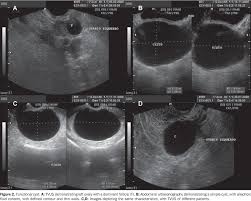Hi, i have a 2.5 cm simple ovarian cyst. Scielo Brasil Ultrassonografia Nas Massas Anexiais Aspectos De Imagem Ultrassonografia Nas Massas Anexiais Aspectos De Imagem