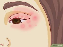 how to treat eczema around the eyes