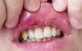 Mundfäule (gingivostomatitis herpetica) ist eine durch herpesviren verursachte mundentzündung. Der Ratselhafte Kleine Wurger Springerlink
