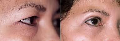 cosmetic asian eyelid surgery