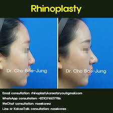 rhinoplasty of a low and short nose tip