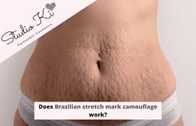 brazilian stretch mark camouflage work