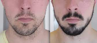 Before and after photos from real minoxidil products user: Good Or Bad Does Rogaine Really Help Grow A Beard
