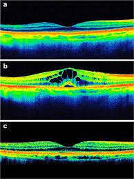 cystoid macular edema ociated with