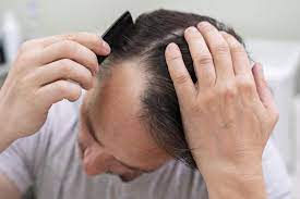 hair thinning on one side of the head