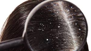 dry scalp sensitive skin dandruff