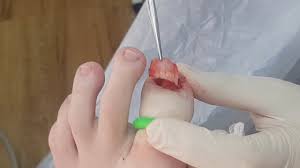 total nail avulsion for ingrown nails