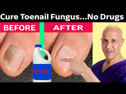 how to cure toenail fungus for pennies