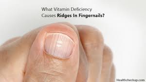 what vitamin deficiency causes ridges