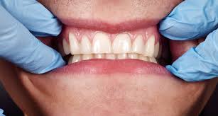 periodontal disease causes batavia ny
