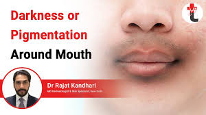 darkness or pigmentation around mouth