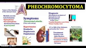 Pheochromocytoma In 3 Mintes Youtube