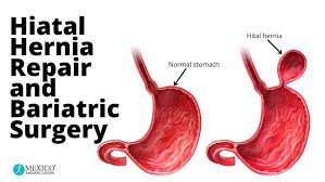 hiatal hernia repair gerd and acid