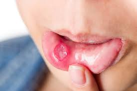 causes of mouth sores and its treatments