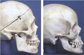 feminization surgery brow bone