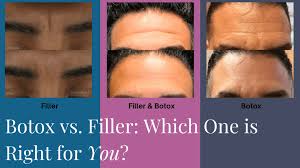 botox vs filler for wrinkles which is