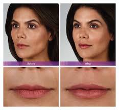 juvederm s albuquerque