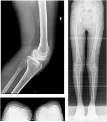 patient with nail patella syndrome imcrj