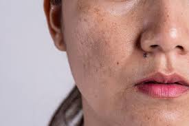 home remes to remove dark spots on