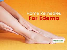 home remes for edema try these