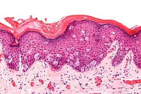 Treatment of paget's disease of the breast: Paget S Disease Of The Breast Libre Pathology