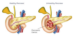treatment for chronic pancreais