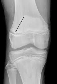 distal fem physeal fractures