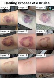 bruising during cancer treatment