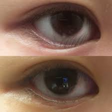 this woman had lower eyelid surgery