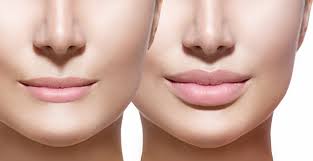 lip fillers types side effects