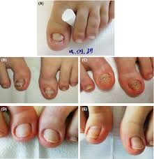 disappearing nail bed caused by trauma