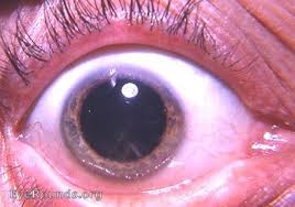 Incipient Cortical Cataract The Inferior Nasal Quadrant