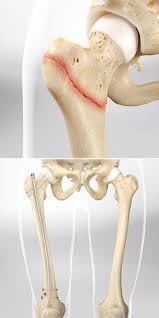 femur fracture fixation with