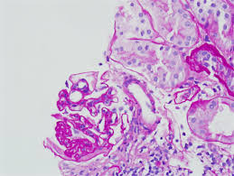 A Case Of Hematuria In A Young Woman Renal And Urology News