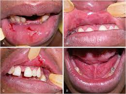 lesions in lips a b c and