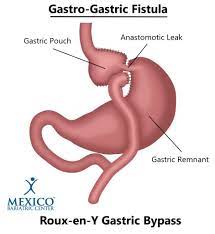 ulcers after gastric byp