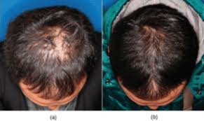 How much does stem cell hair restoration cost? Stem Cell Therapy For Hair Loss Irvine Oc Hair Restoration