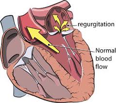 The mitral valve (/ˈmaɪtrəl/), also known as the bicuspid valve or left atrioventricular valve, is a valve with two flaps in the heart that lies between the left atrium and the left ventricle. Mitral Regurgitation Symptoms Diagnosis Treatment Surgery