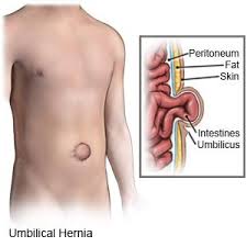 umbilical hernia swollen belly on