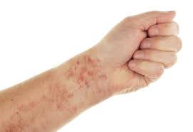 skin blanching test tell you if a rash