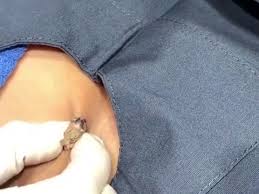 An ingrown hair armpit cyst or lump may become painful and unbearable when infected. Dr Pimple Popper See This Giant Armpit Cyst Pour Out Looking Like A Turkey Meatball