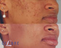 acne scar removal before and after