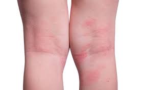eczema in es children and
