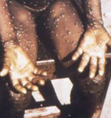 The virus was first discovered in monkeys (hence the name) in 1958, and in humans in 1970. The Eight Symptoms Of Rare Monkeypox Virus To Be Aware Of As Two Cases Confirmed In North Wales North Wales Live