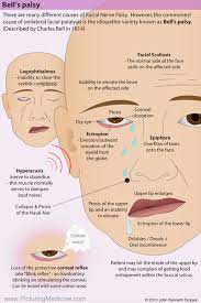 bell s palsy there are many diffe