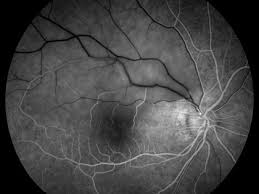 eye conditions retina macula insute