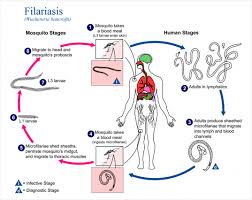 what is filariasis causes symptoms