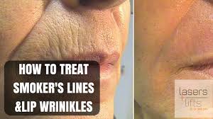 upper lip wrinkles and smoker s lines